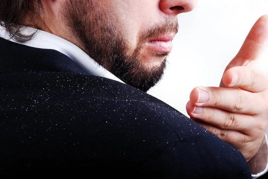 "Pellicules dans la barbe ? Voici comment s’en débarrasser définitivement".